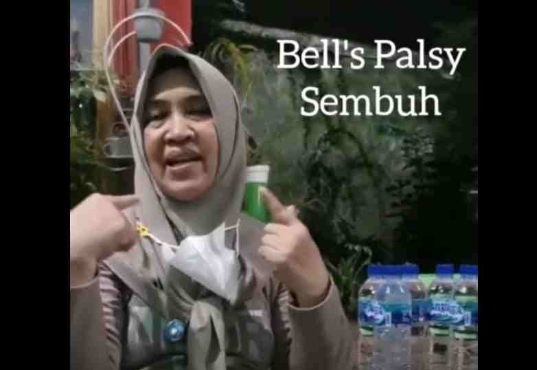 Bells Palsy 2